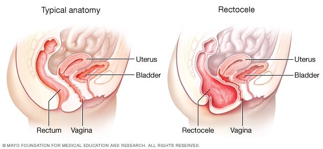 正常解剖结构和阴道后壁脱垂（直肠膨出）