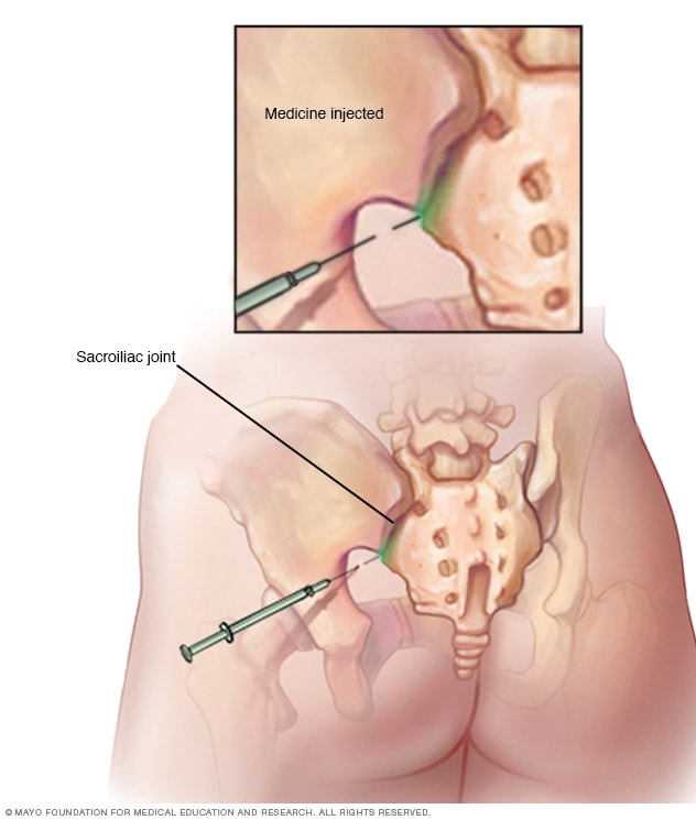 Sacroileitis Cirugia De Columna En Matamoros