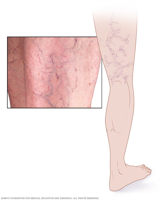 Varicose vein on a female senior legs. The structure of normal and varicose  veins. Concept of dry skin, old senior people and deep vein thrombosis or  Stock Photo - Alamy