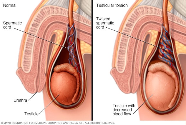 Illustration of penis before and during testicular torsion