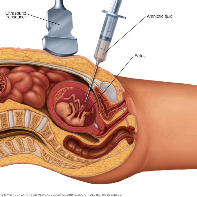 Qué es la amniocentesis? ¿Pueden realizarla todas las mujeres