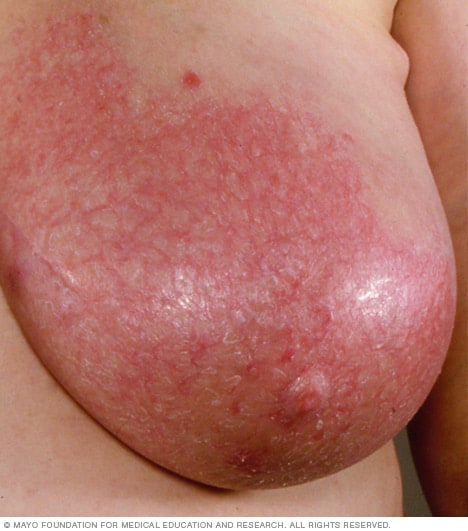 mastitis in women symptoms