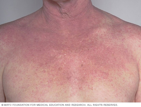 Localized eczematous rash affecting left and right regions of