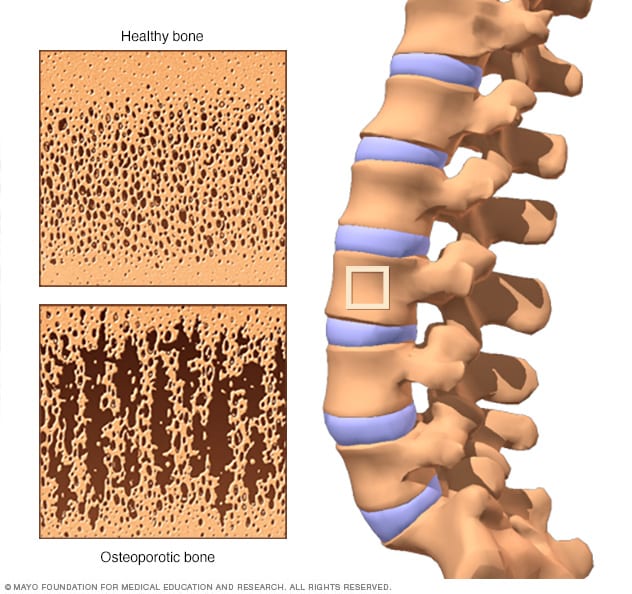 Natural treatments for osteoporosis: Exercise, diet, and more