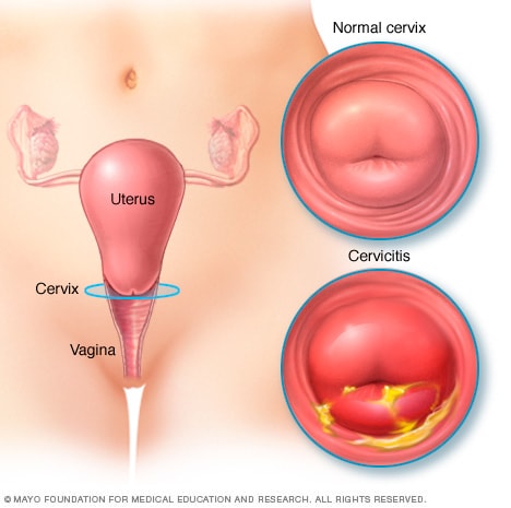 正常宫颈与发生宫颈炎的宫颈图示 