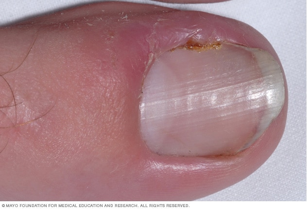 Ingrown toenails - Symptoms and causes - Mayo Clinic