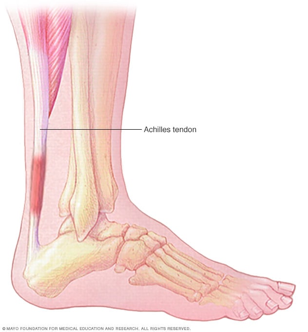Achilles tendinitis - Symptoms and 