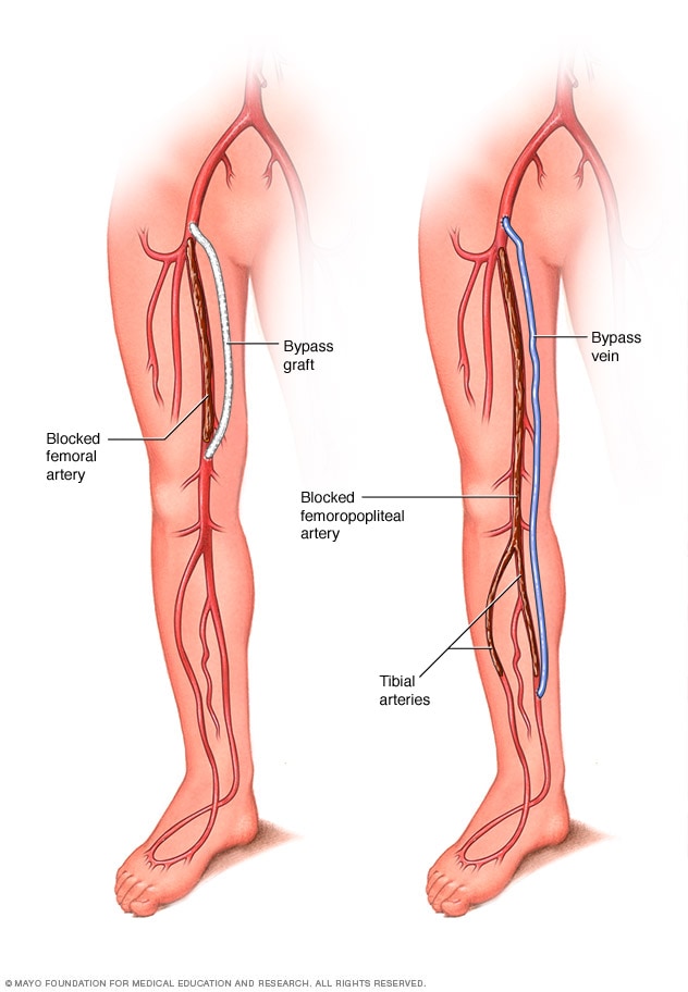 femoral artery pain