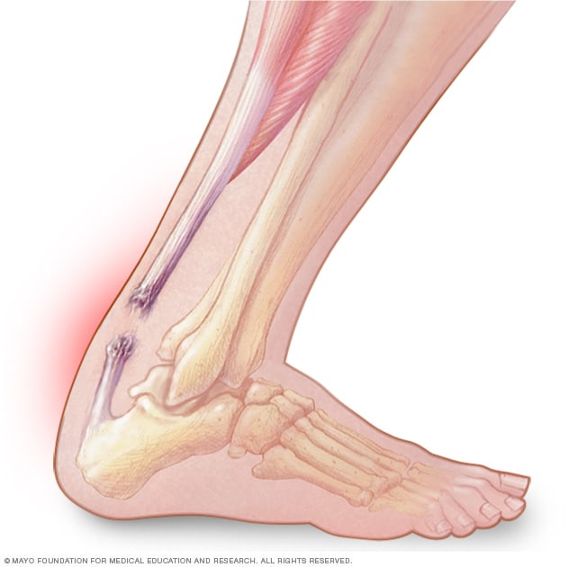 Achilles tendon rupture - Symptoms and 