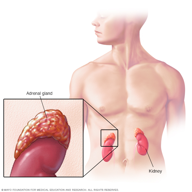 adrenal nodule on kidney