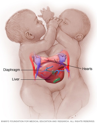 Conjoined Twins Symptoms And Causes Mayo Clinic