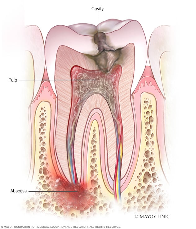 أعراض خراج الأسنان وأسبابه في Mayo Clinic
