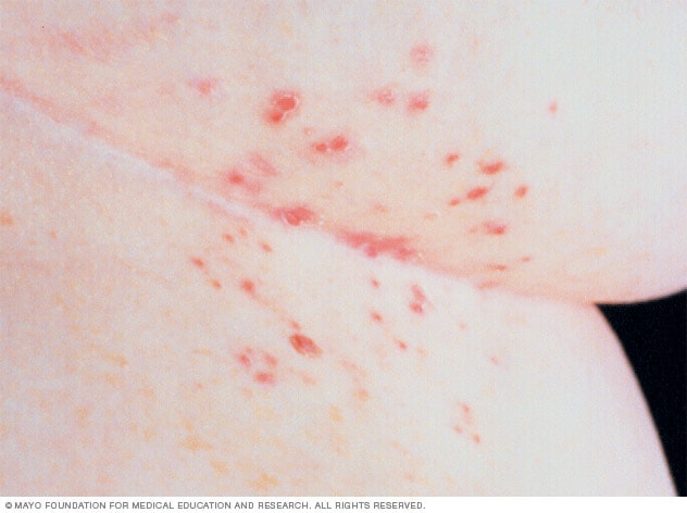 Scabies - Symptoms and causes - Mayo Clinic