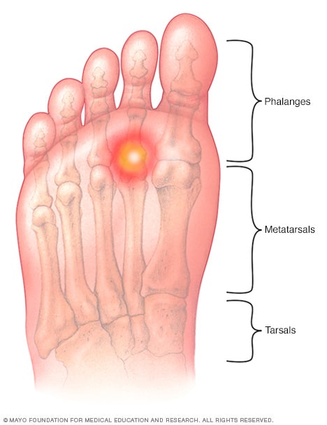 inflammation in the foot sole