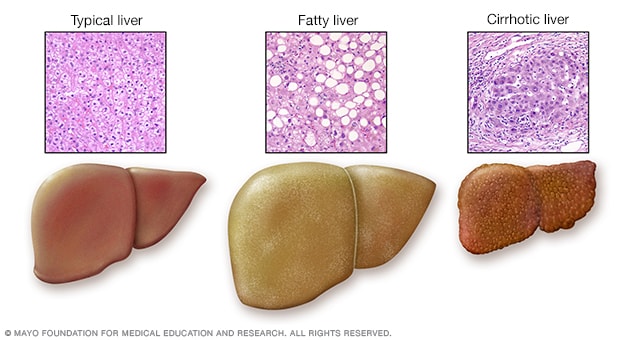 显示典型肝脏和患病肝脏的肝脏问题