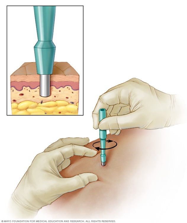 穿孔活检的特写显示了组织被移除的层。一幅较大的图像显示了该工具是如何放置在皮肤上并拧入的。