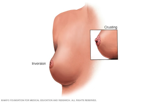 Understanding the Different Types of Breast Cancer: Characteristics and  Variations Explained