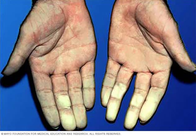 Raynaud's disease - Symptoms and causes - Mayo Clinic