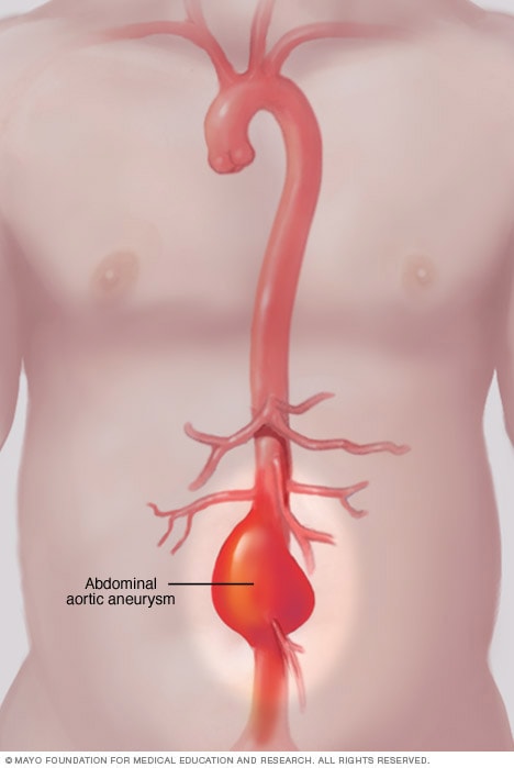 abdominal aortic aneurysm xray