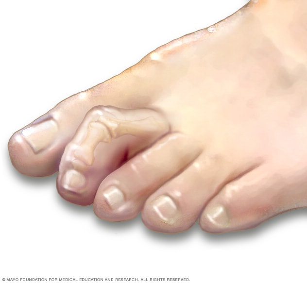 Hammertoe and mallet toe - Symptoms and causes - Mayo Clinic