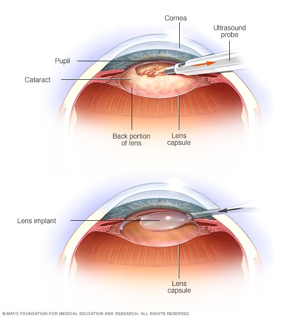 Cataract Surgery Mayo Clinic