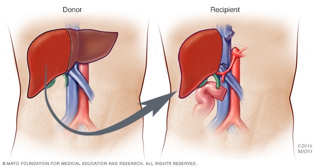 Trasplante de hígado con donante vivo