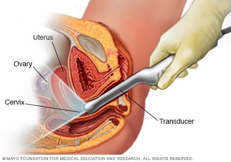 Endometriosis y embarazo: prevención y seguimiento clínico para evitar  complicaciones
