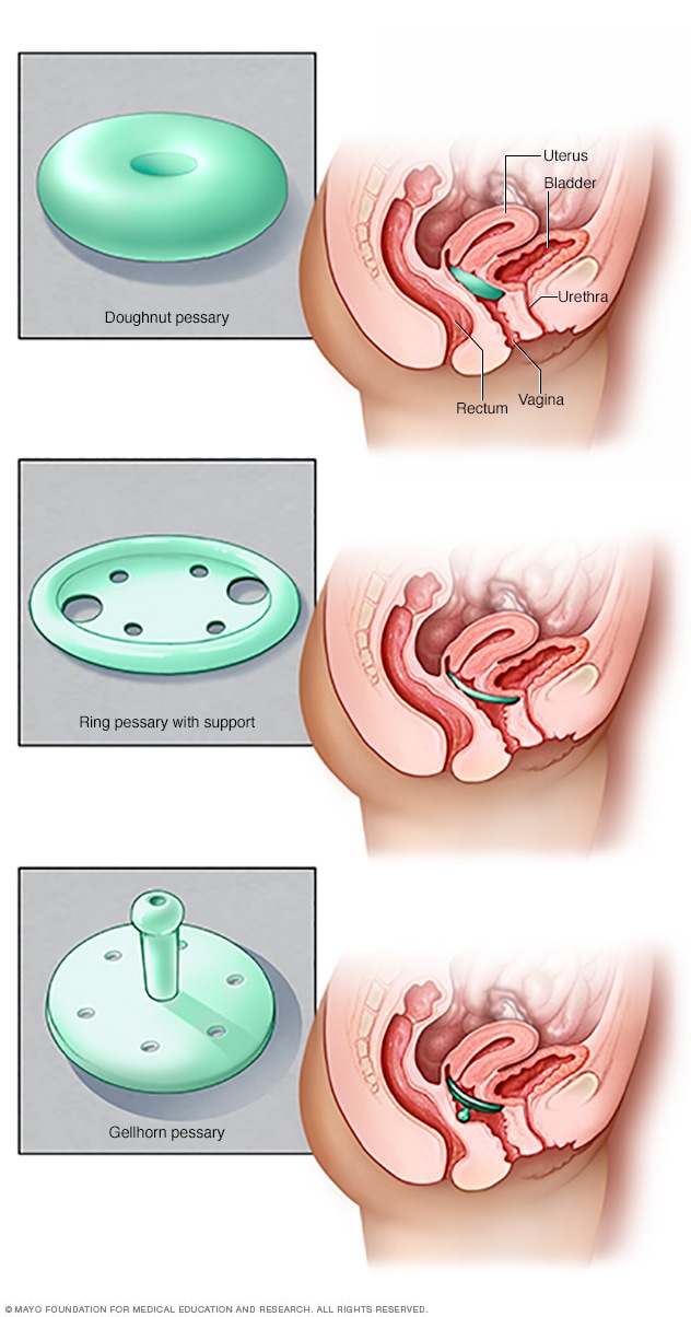Anterior vaginal prolapse (cystocele) - Diagnosis and treatment