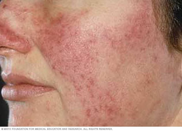 Rosacea Symptoms and causes - Mayo