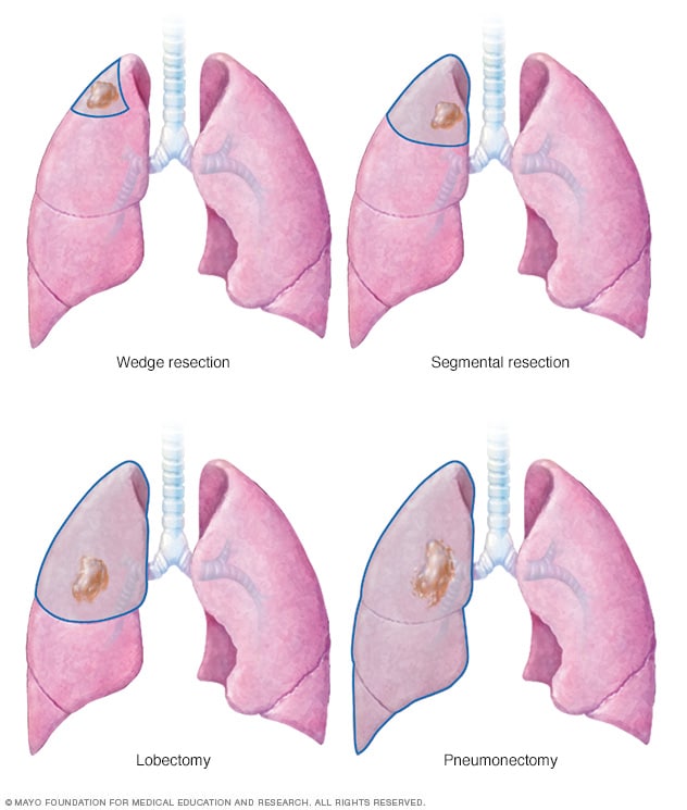 Lung cancer surgery - Mayo Clinic