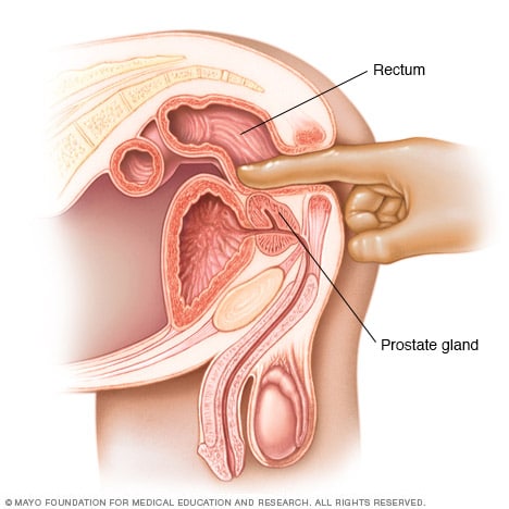 Digital rectal exam - Mayo Clinic lower abdominal incision diagram 