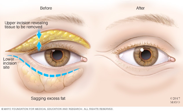 تشخيص وعلاج أكياس تحت العين Mayo Clinic