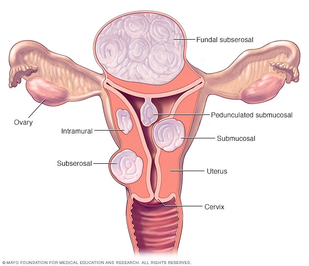 Diferentes tipos de fibromas uterinos y sus ubicaciones
