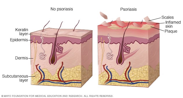 Ostraceous le psoriasis. Des parcelles de peau psoriasique