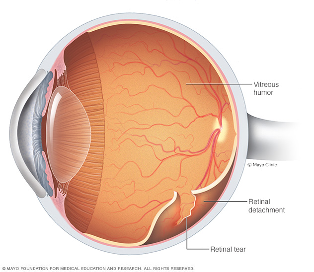 signs of a detached retina