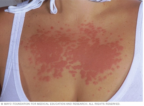 Sun allergy - causes - Clinic