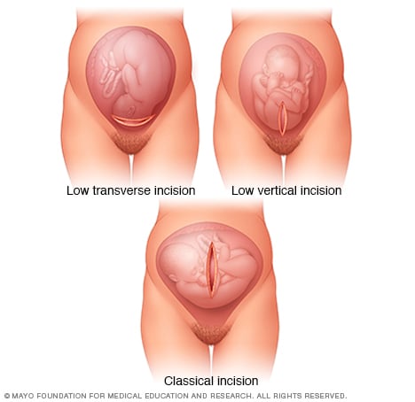The Effects of C-Section Pain