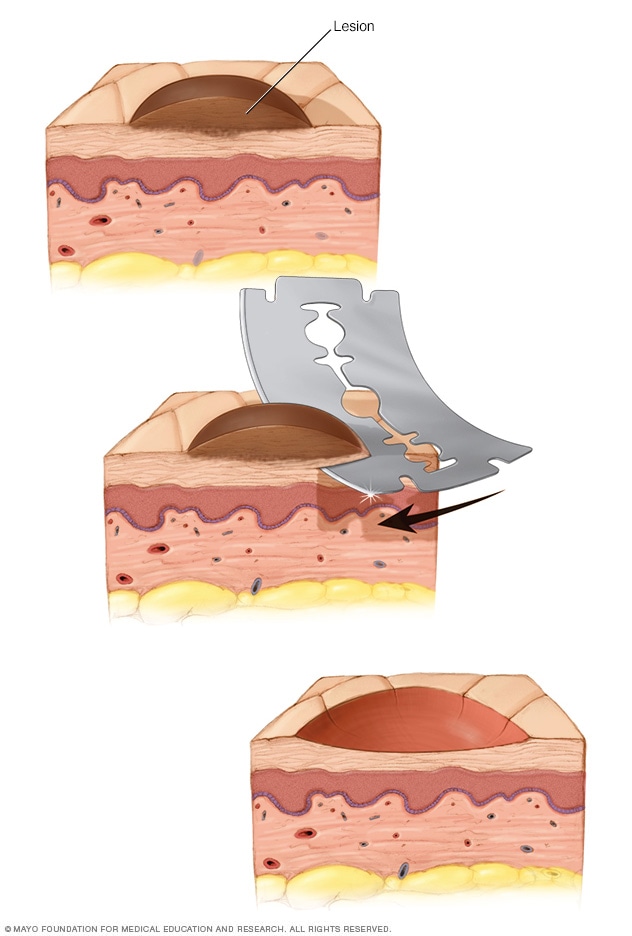Shave biopsy Mayo Clinic