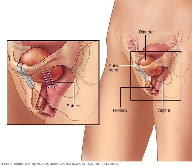 What causes loss of bladder control in females? 