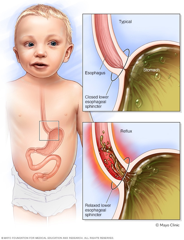 Infant reflux - Symptoms and causes 