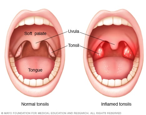 tonsillectomy tonsils inflamed