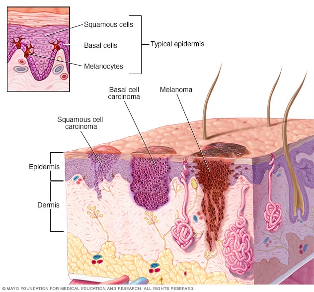 Skin Cancer Pictures, Skin Cancer Images, What Does Skin Cancer Look  Like?