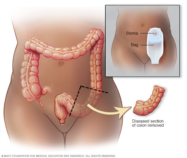 Ostomy: Adapting to life after colostomy, ileostomy or urostomy - Mayo  Clinic