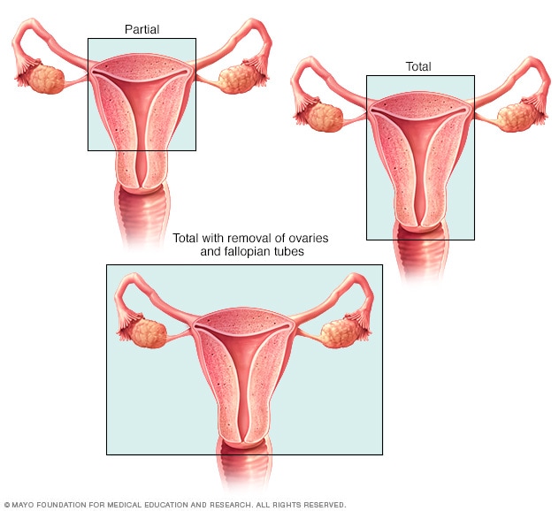 Types Of Hysterectomy Surgery Mayo Clinic
