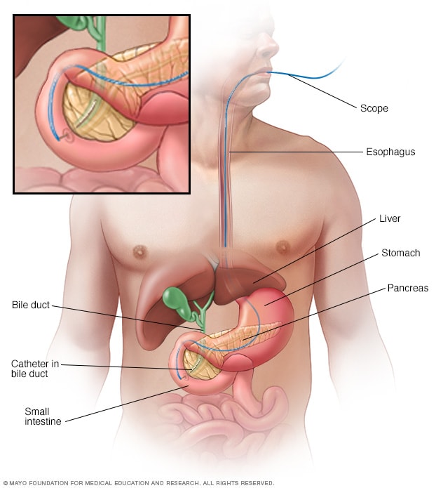 ERCP: What It Is, Why It's Done, Procedure & Complications