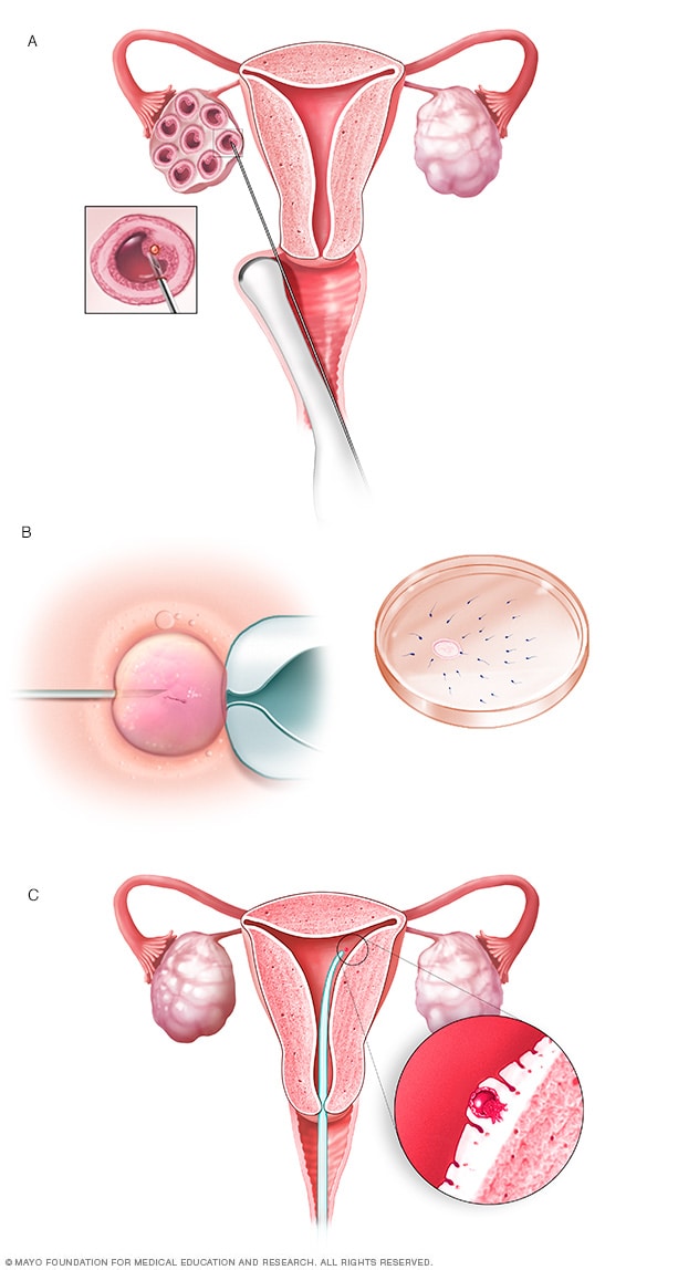 in vitro fertilization embryos