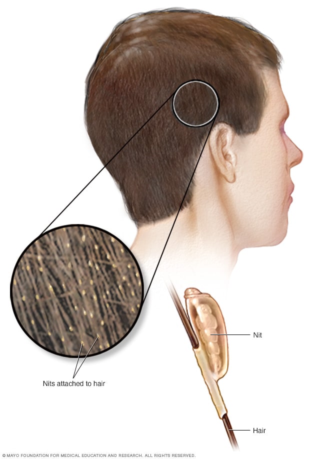 Lice - Symptoms and causes - Mayo Clinic diagram fly cast 