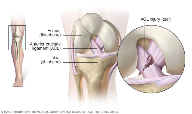 surgery for acl