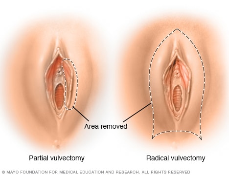 vulvectomy anterior