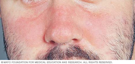 what causes seborrheic dermatitis face